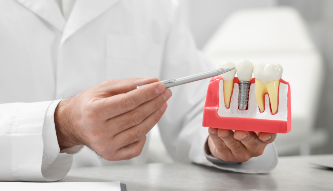 Transform Your Smile with Confidence The Ultimate Guide to Dental Implants at Smiles at Richmond Hill