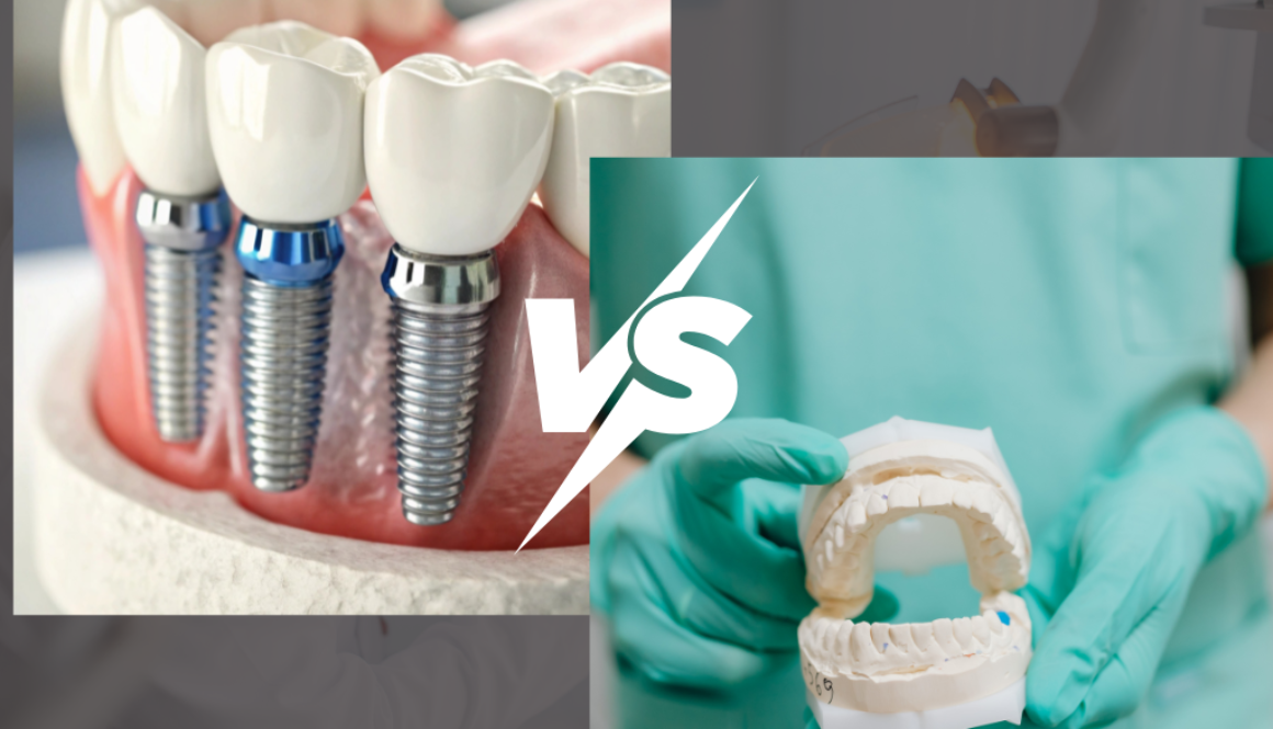 Dental Implants vs. Dentures and Veneers Making the Right Choice for Your Smile in Richmond Hill