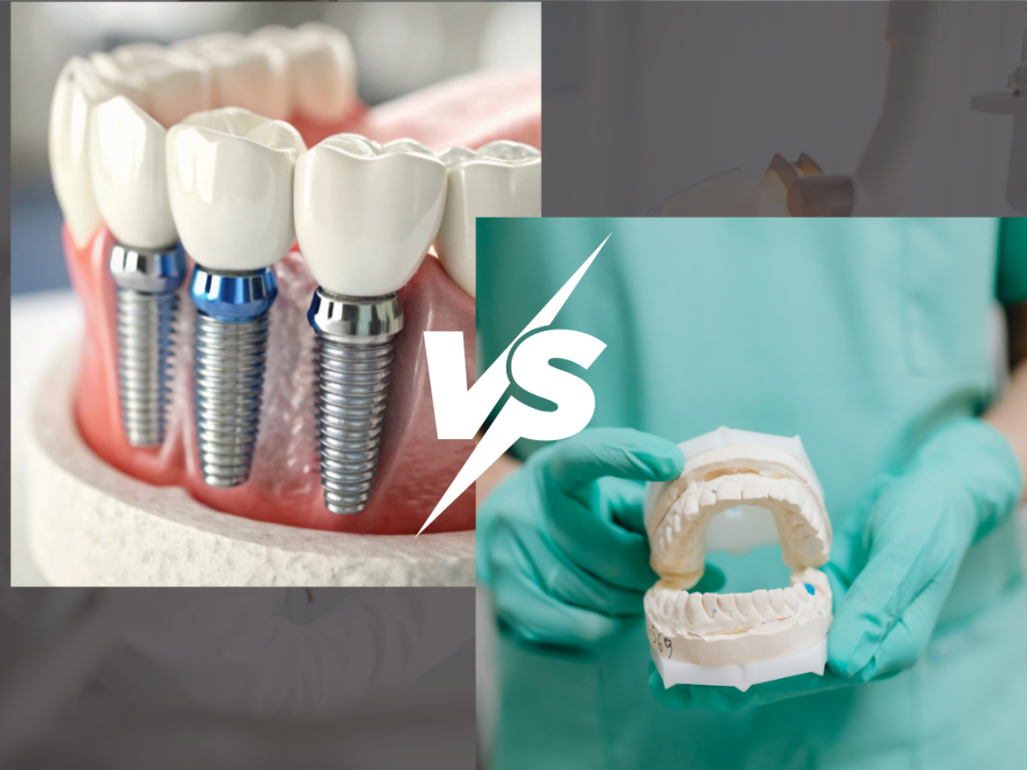 Dental Implants vs. Dentures and Veneers: Making the Right Choice for Your Smile in Richmond Hill