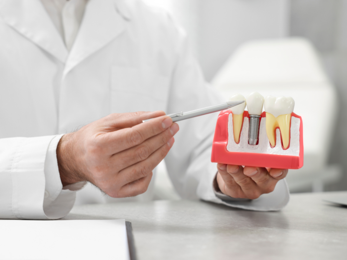 Transform Your Smile with Confidence The Ultimate Guide to Dental Implants at Smiles at Richmond Hill